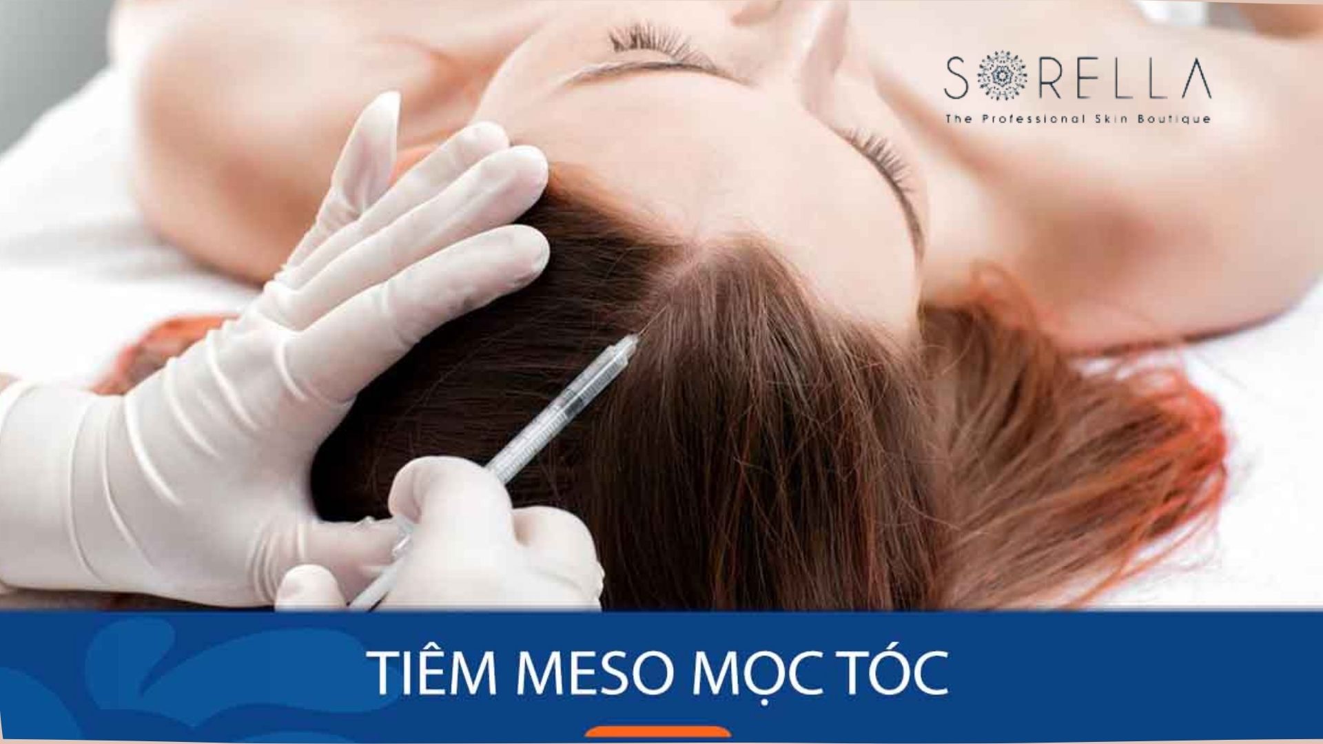 Tiêm Meso mọc tóc và 5 câu hỏi thường gặp