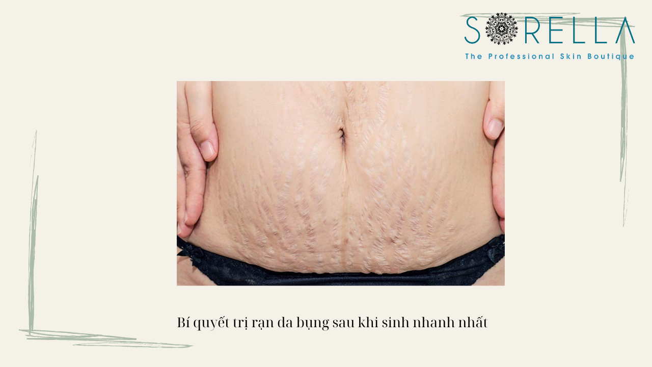 Rạn da bụng sau sinh là như thế nào? 