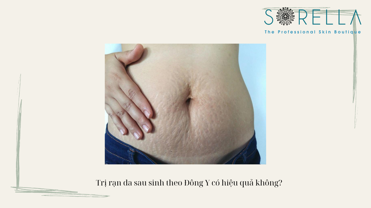 Rạn da bụng sau sinh là như thế nào? 