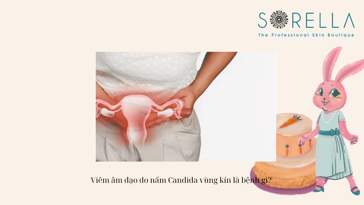 Viêm âm đạo do nấm Candida vùng kín