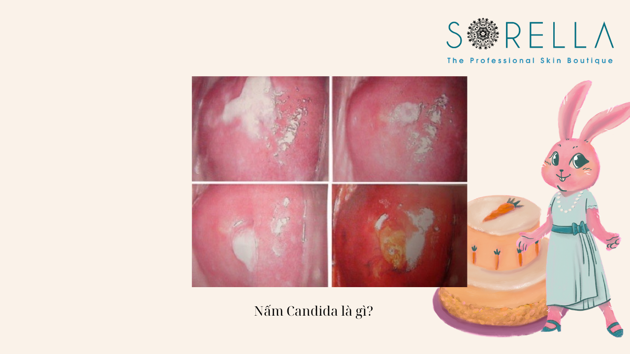 Viêm âm đạo do nấm Candida vùng kín 