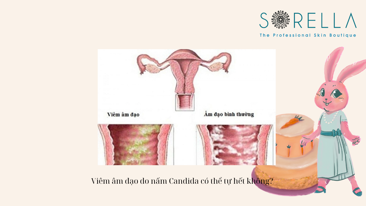 Viêm âm đạo do nấm Candida vùng kín