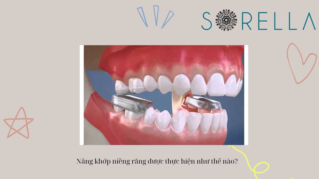 Hàm nâng khớp tháo lắp