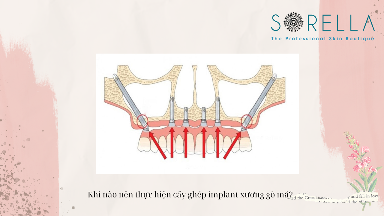 Cấy ghép implant xương gò má là gì? 