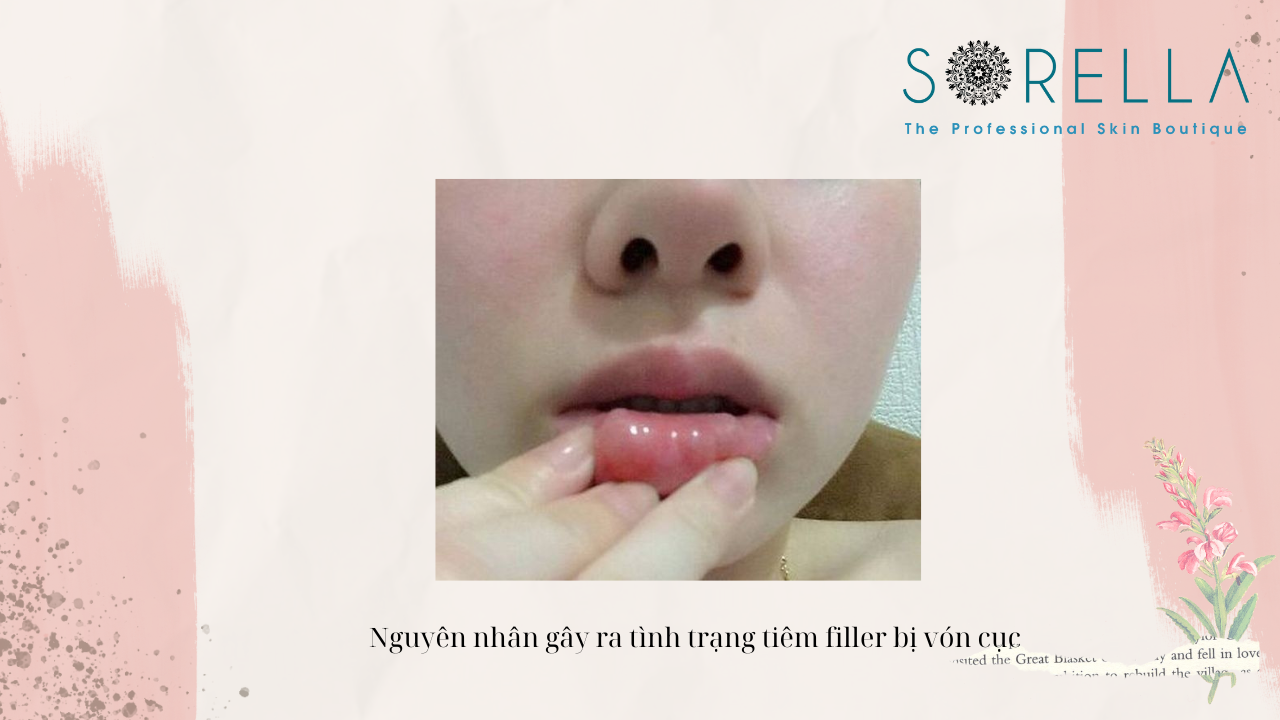 Tiêm filler bị vón cục có nguy hiểm không?