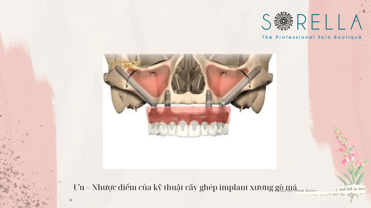 Cấy ghép implant xương gò má là gì? 