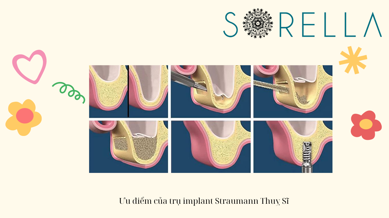 Trụ implant Straumann Thuỵ Sĩ 