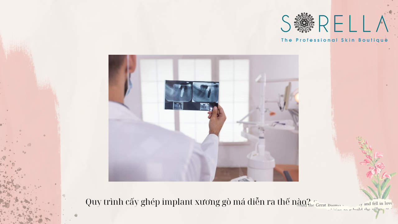 Cấy ghép implant xương gò má là gì? 