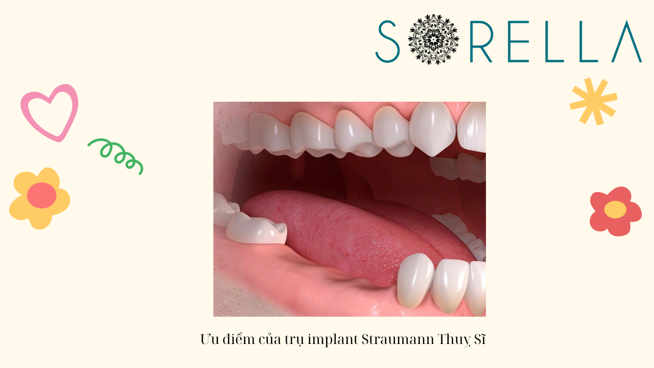 Trụ implant Straumann Thuỵ Sĩ 