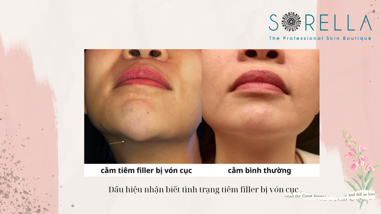 Tiêm filler bị vón cục có nguy hiểm không?