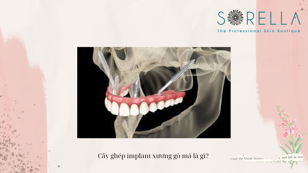 Cấy ghép implant xương gò má là gì? 