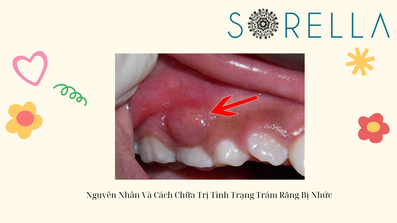 Trám răng xong bị nhức?