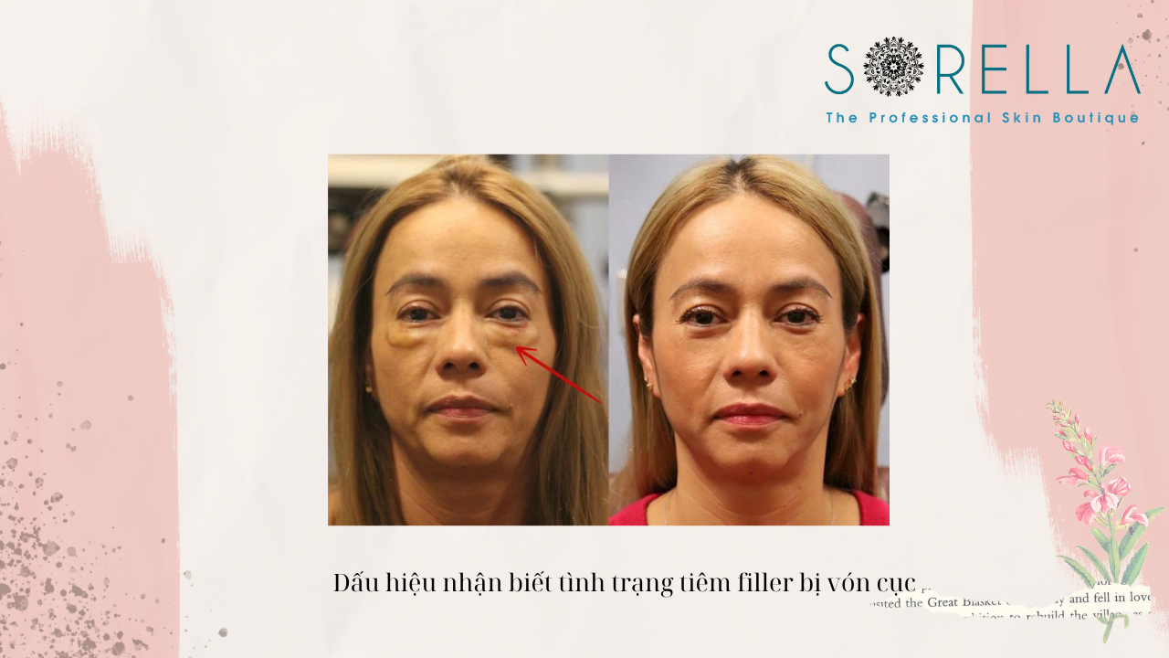 Tiêm filler bị vón cục có nguy hiểm không?