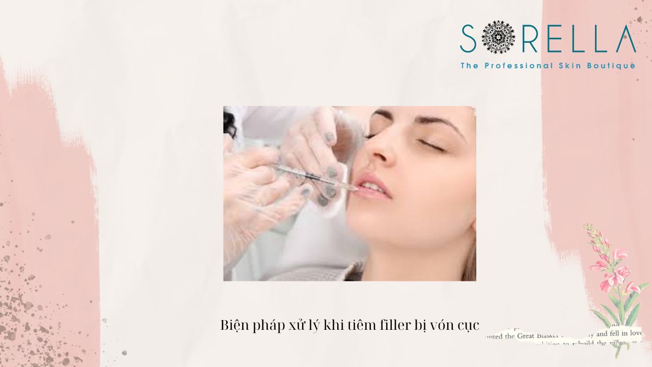 Tiêm filler bị vón cục có nguy hiểm không?