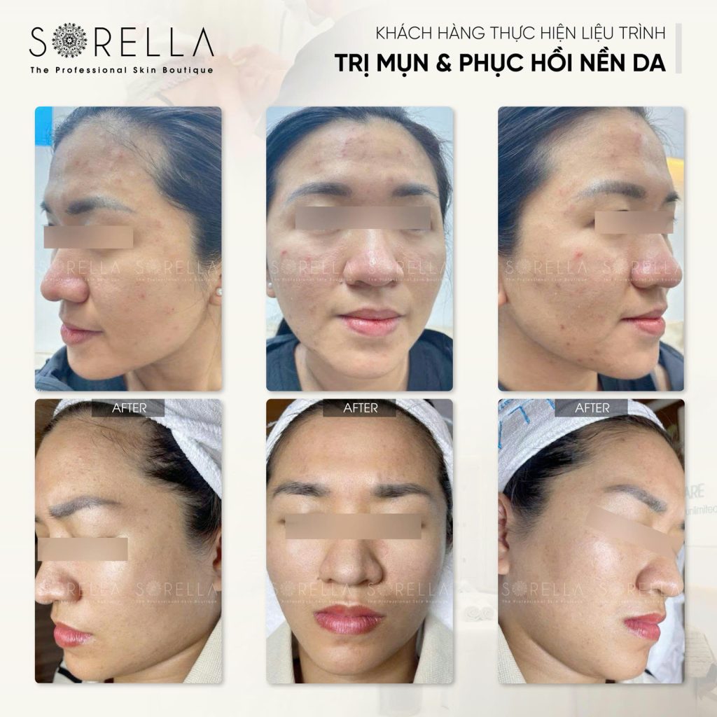 Premium Acne Clear