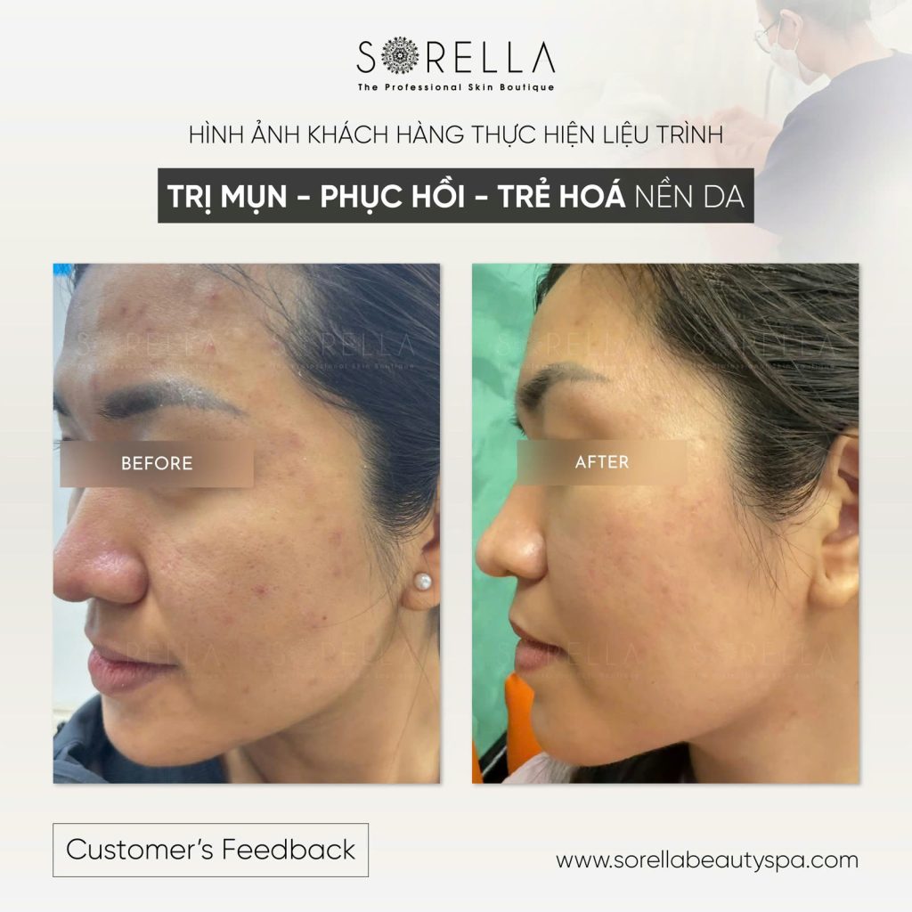 Premium Acne Clear