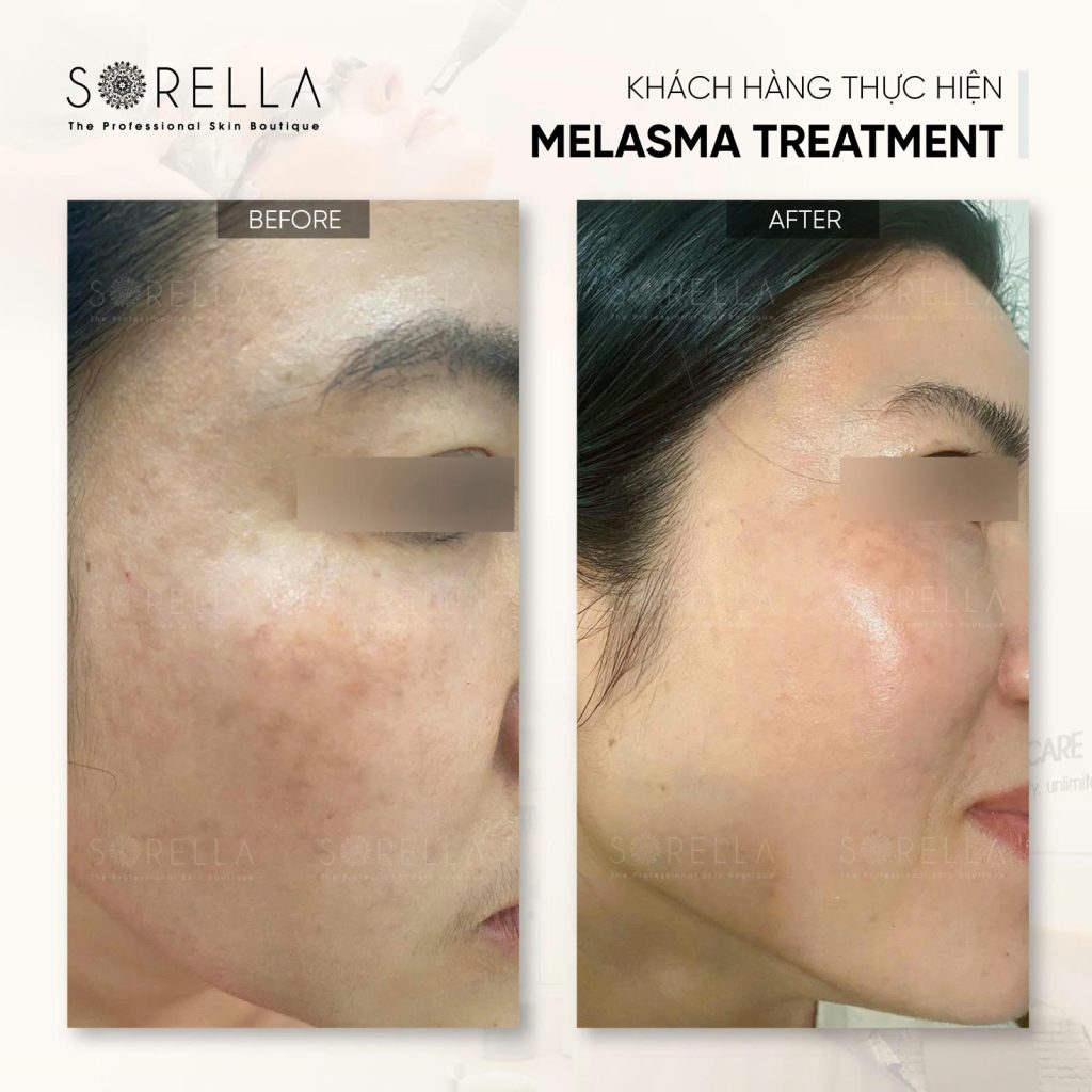 MESO MELASMA CARE