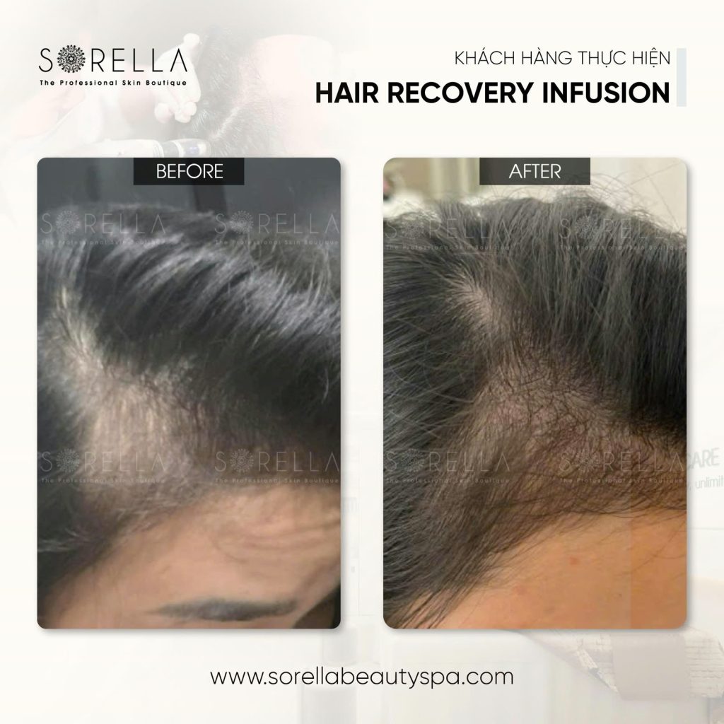 MESO HAIR REVIVE