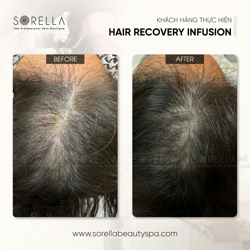 Hair Recovery Infusion