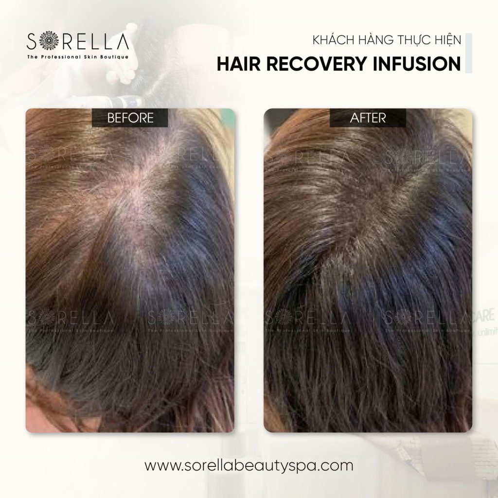 MESO HAIR REVIVE
