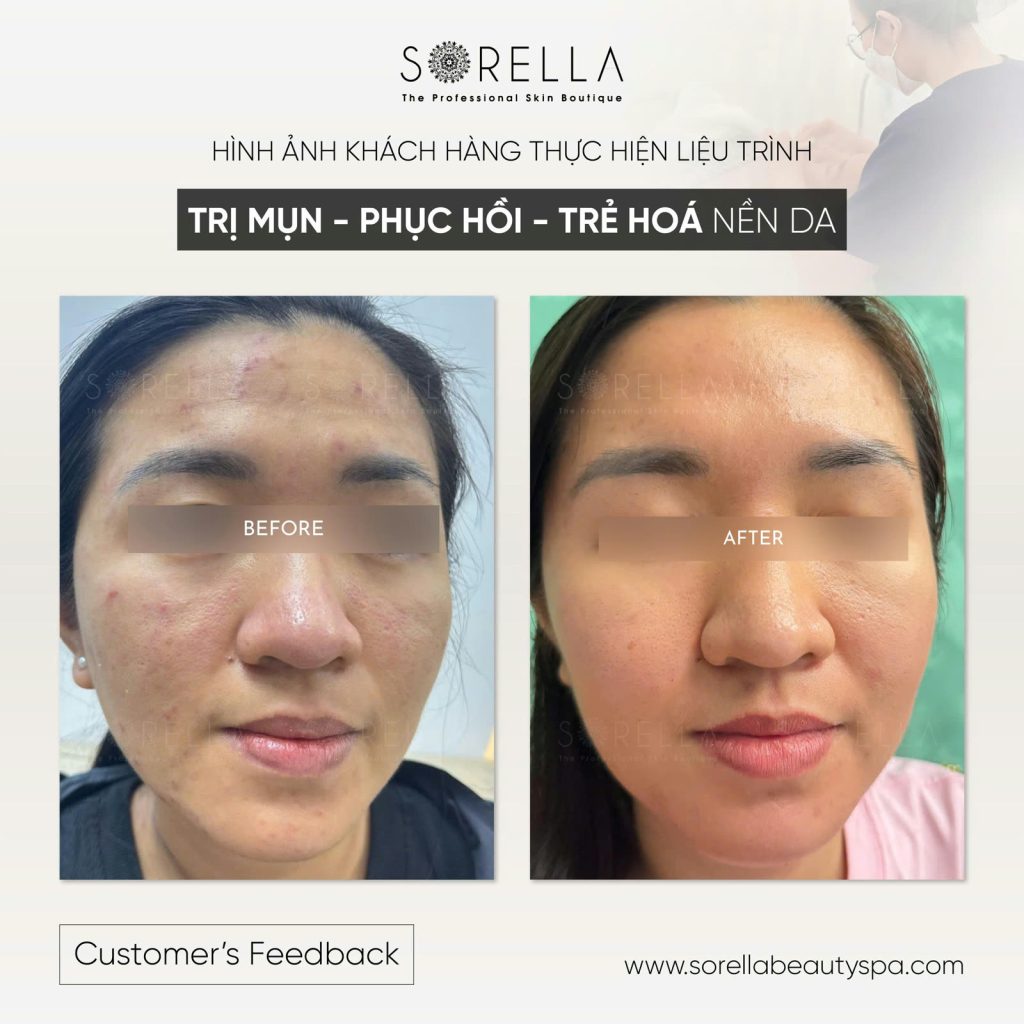 Premium Acne Clear