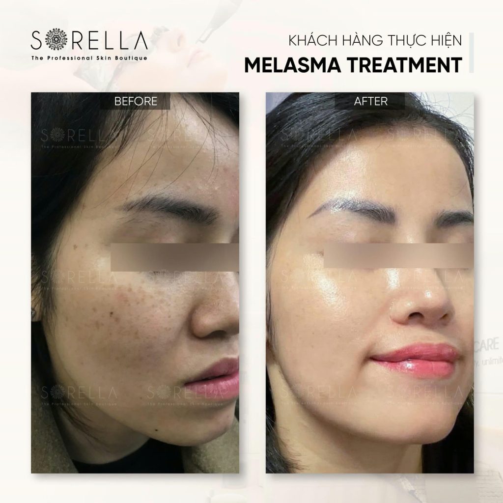 MESO MELASMA CARE