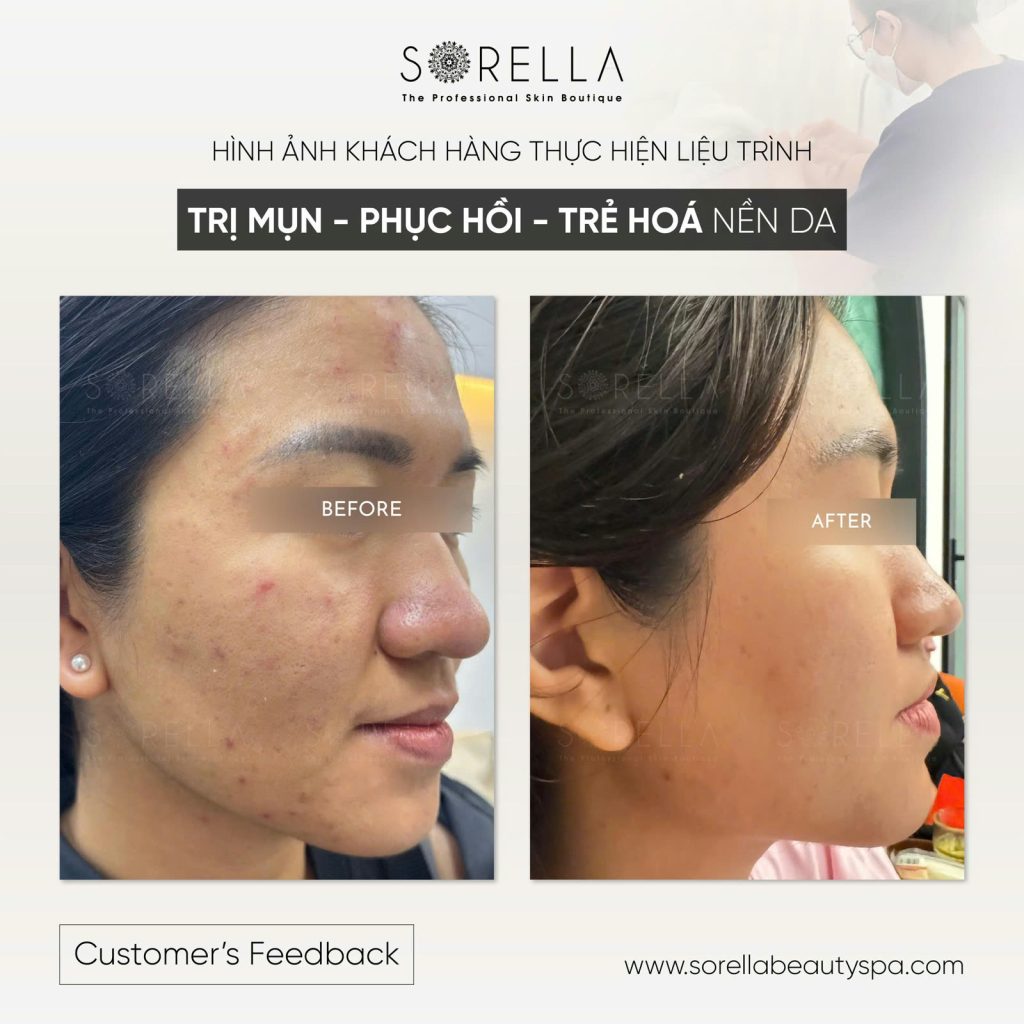 Premium Acne Clear