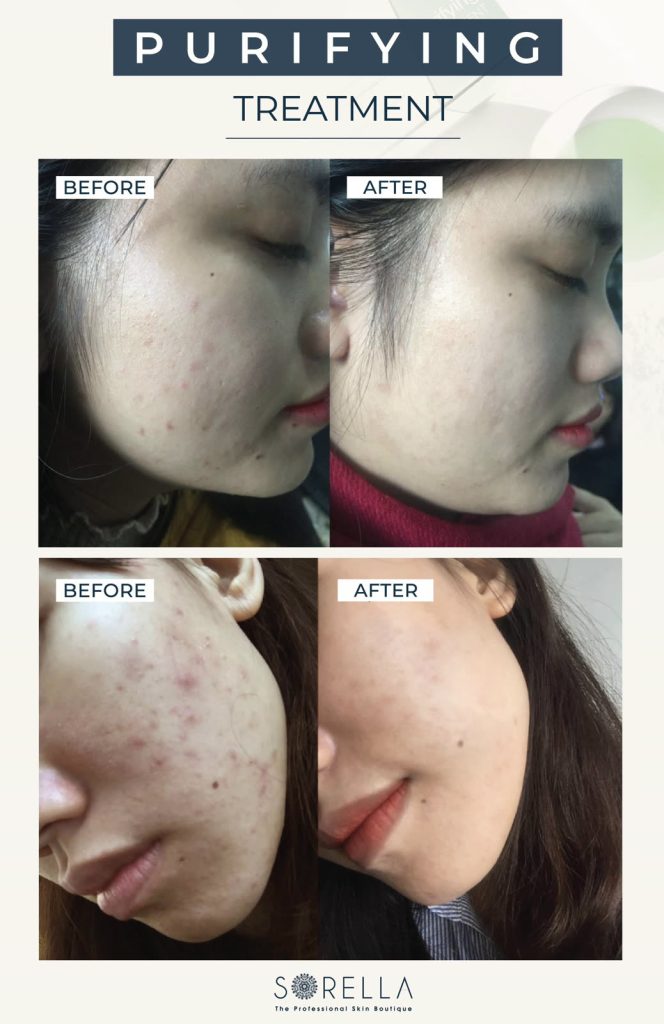 Purifying Treatment