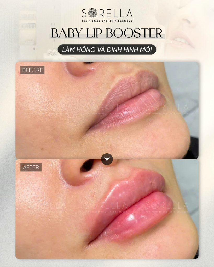 MESO LIP BOOSTER - trước & sau