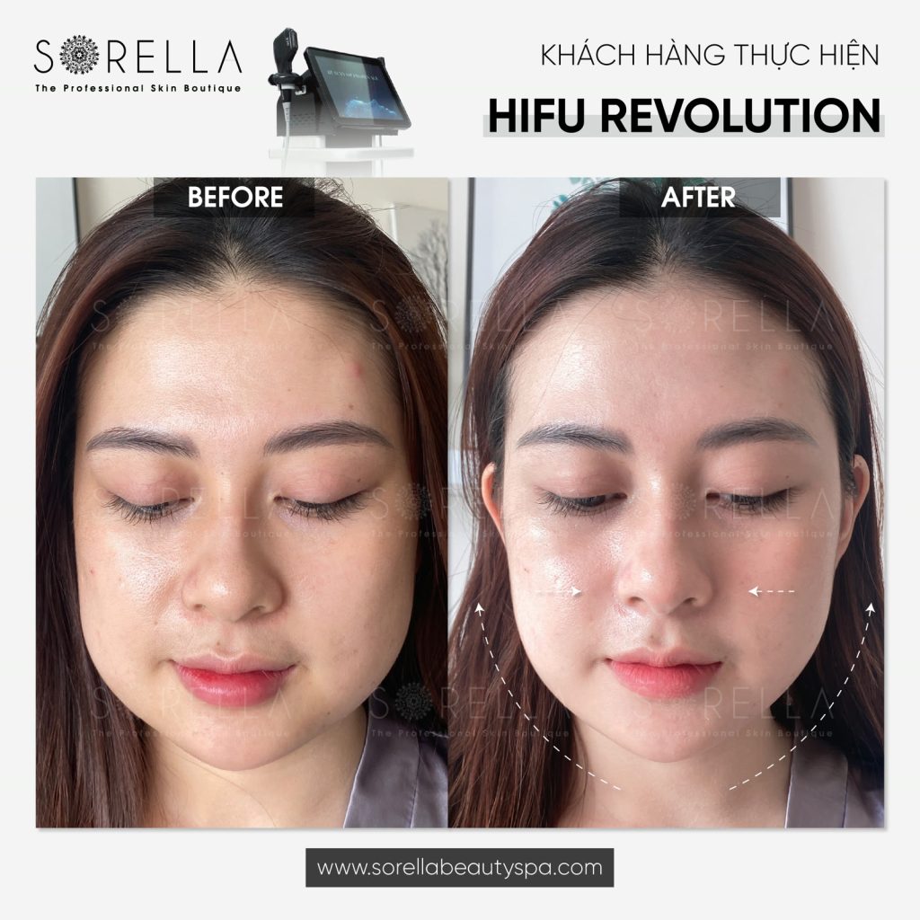 Hifu Revolution - trước & sau