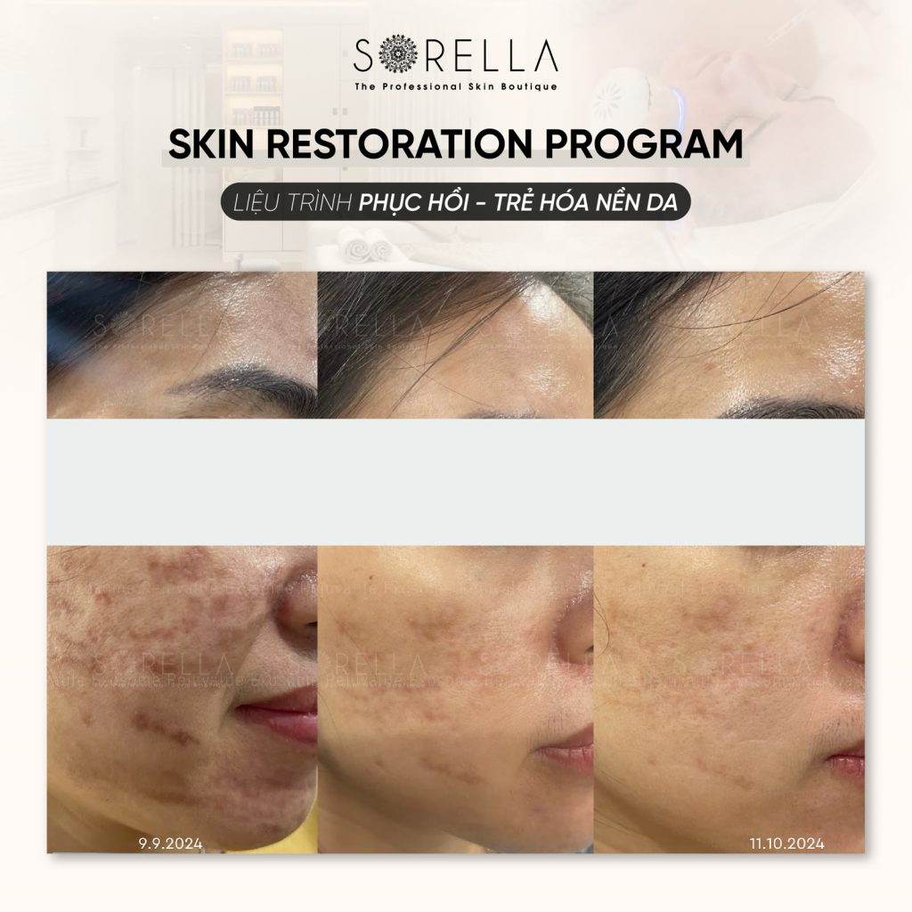 MESO LINERASE (COLLAGEN) - trước & sau