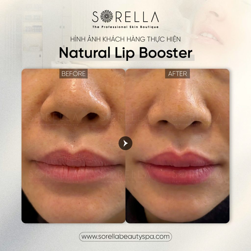 MESO LIP BOOSTER - trước & sau