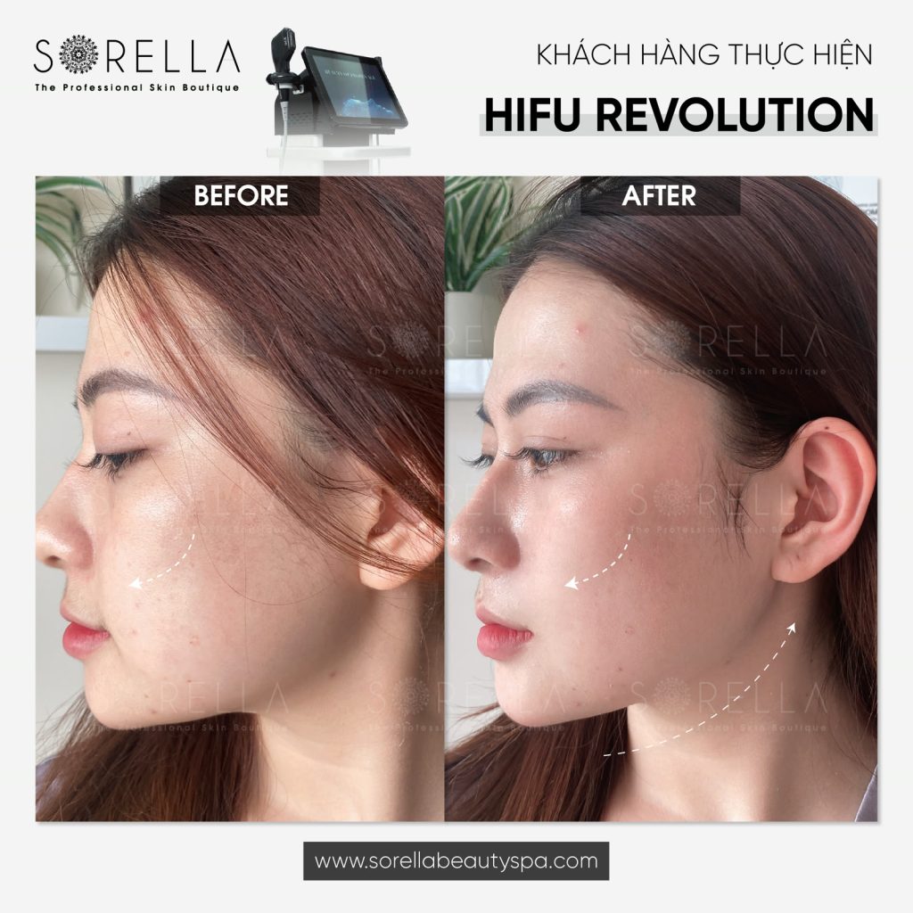 Hifu Revolution - trước & sau