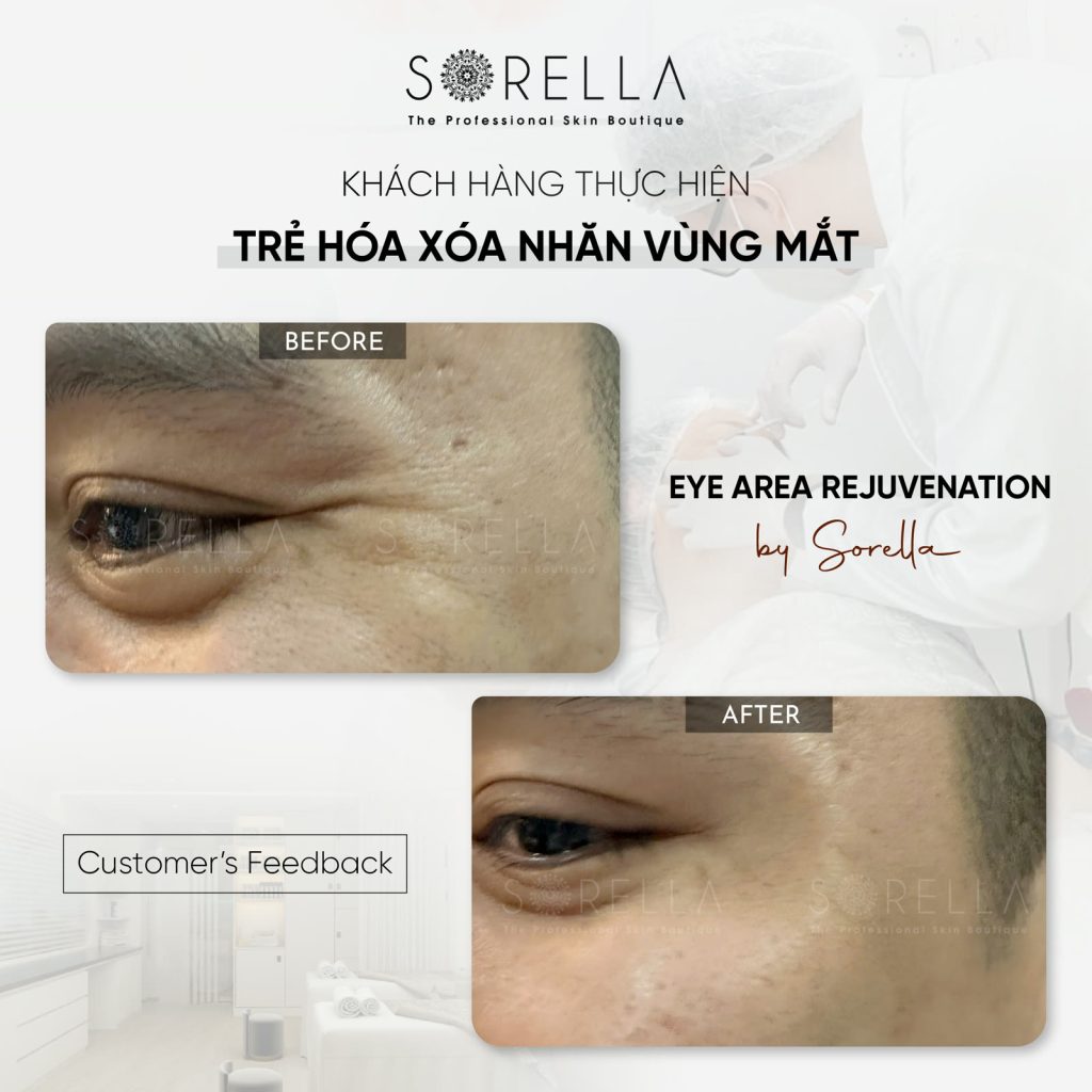 MESO REJURAN EYES - trước & sau