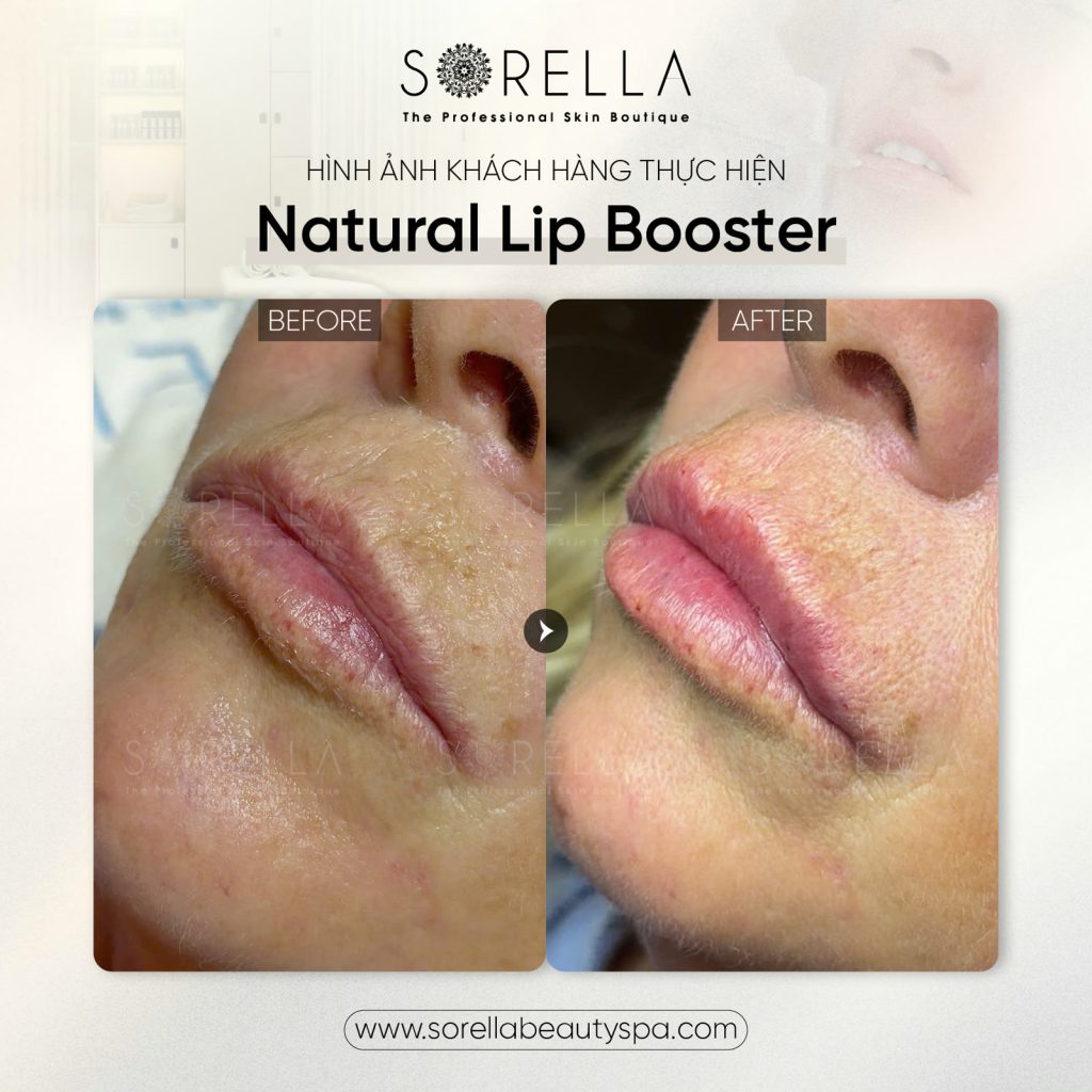 MESO LIP BOOSTER - trước & sau