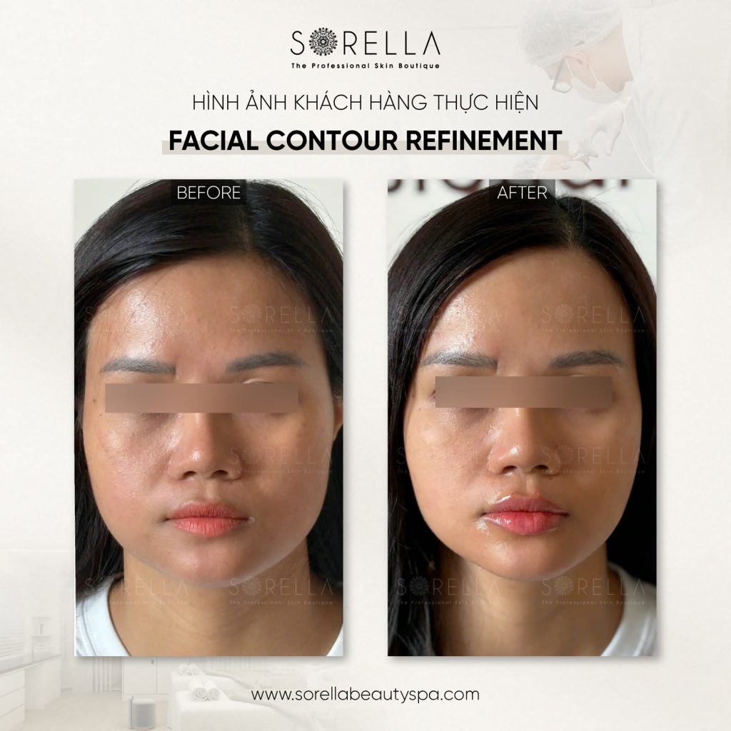 MESO FAT REDUCTION - trước & sau