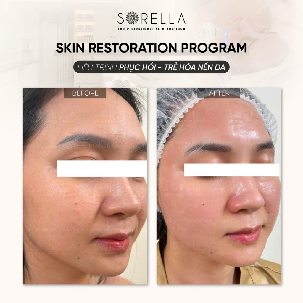 MESO REJURAN HEALER (2cc) - trước & sau