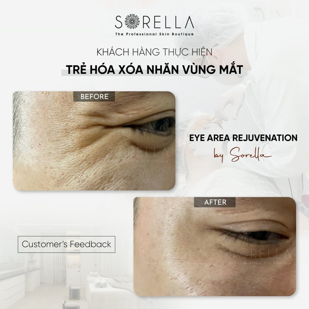 MESO REJURAN EYES - trước & sau