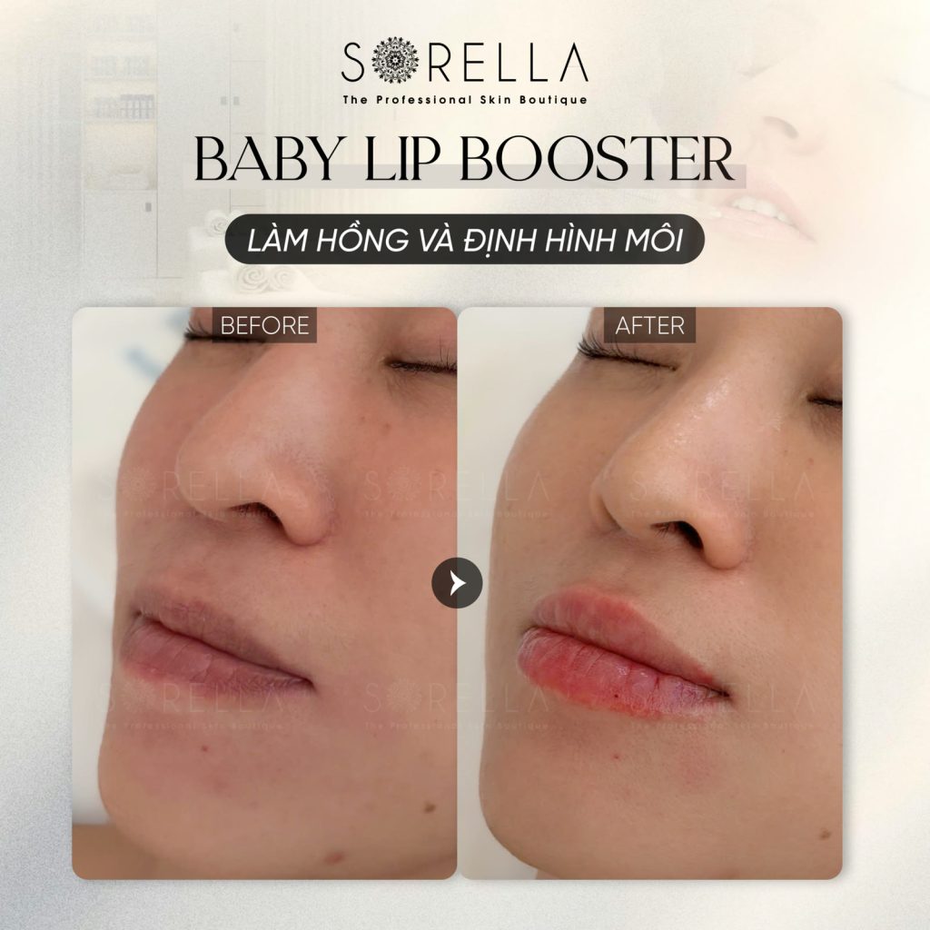 MESO LIP BOOSTER - trước & sau