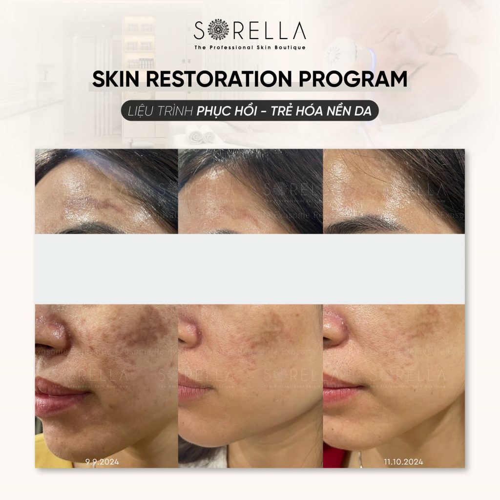 MESO LINERASE (COLLAGEN) - trước & sau