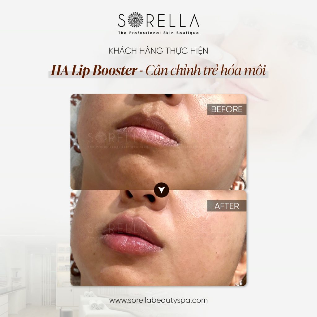MESO LIP BOOSTER - trước & sau