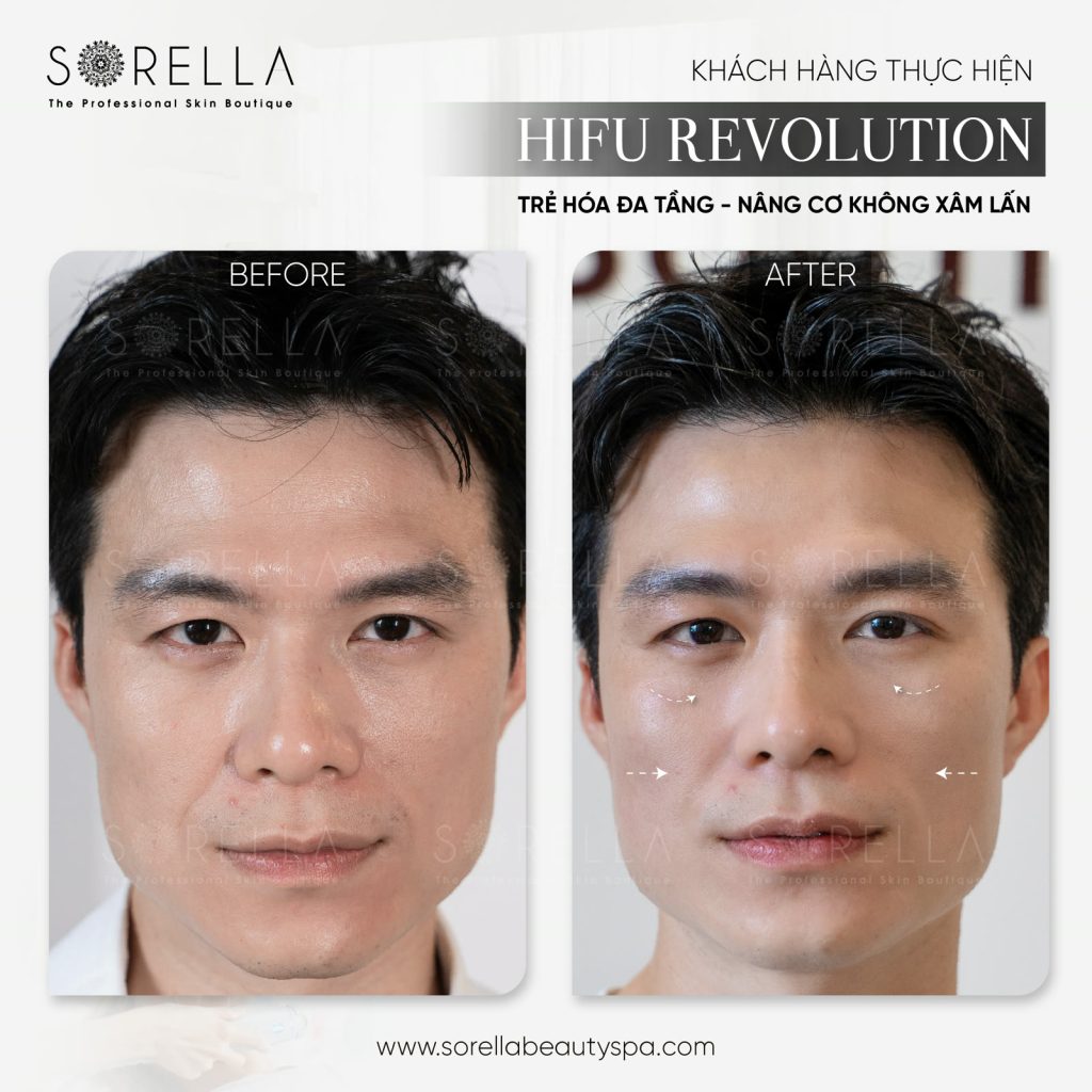 Hifu Revolution - trước & sau