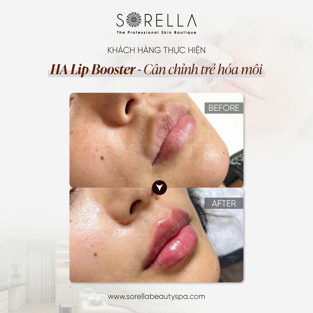 MESO LIP BOOSTER - trước & sau