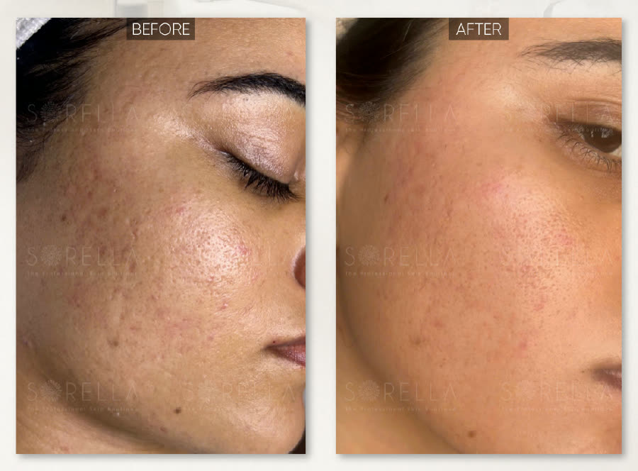 Acne Scar Treatment