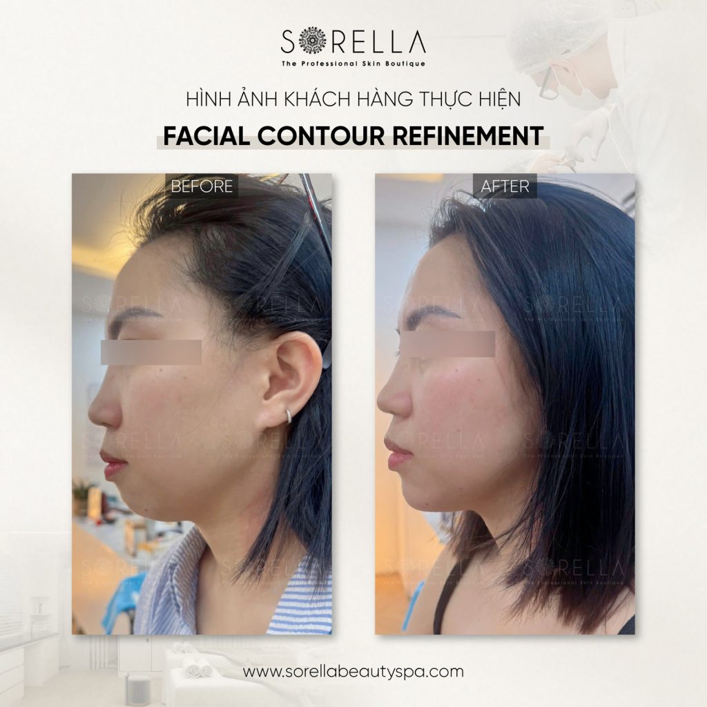 Thermage FLX - trước & sau