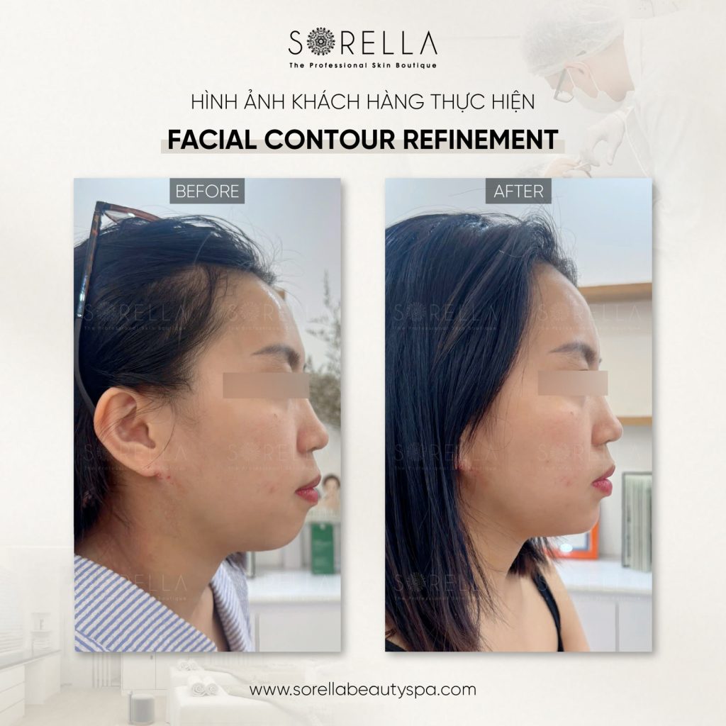 Thermage FLX - trước & sau