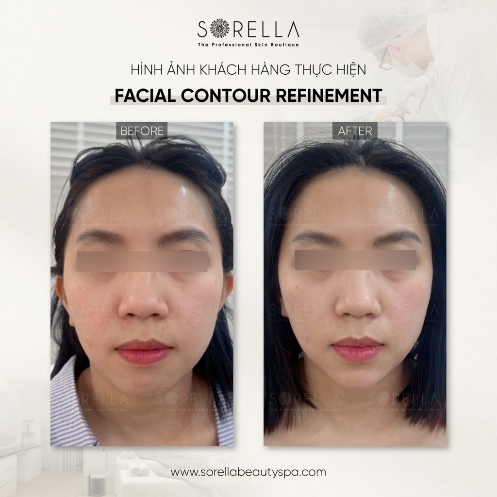 Thermage FLX - trước & sau