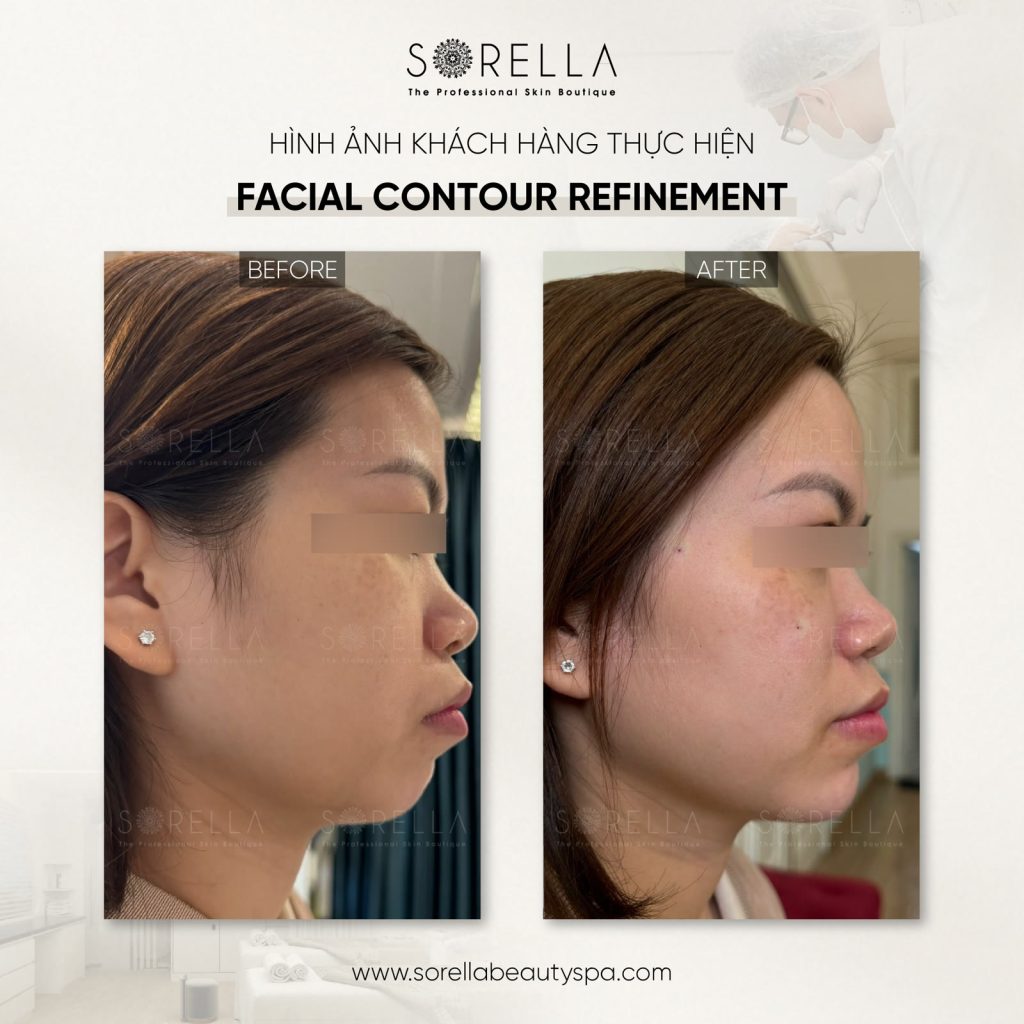 Thermage FLX - trước & sau
