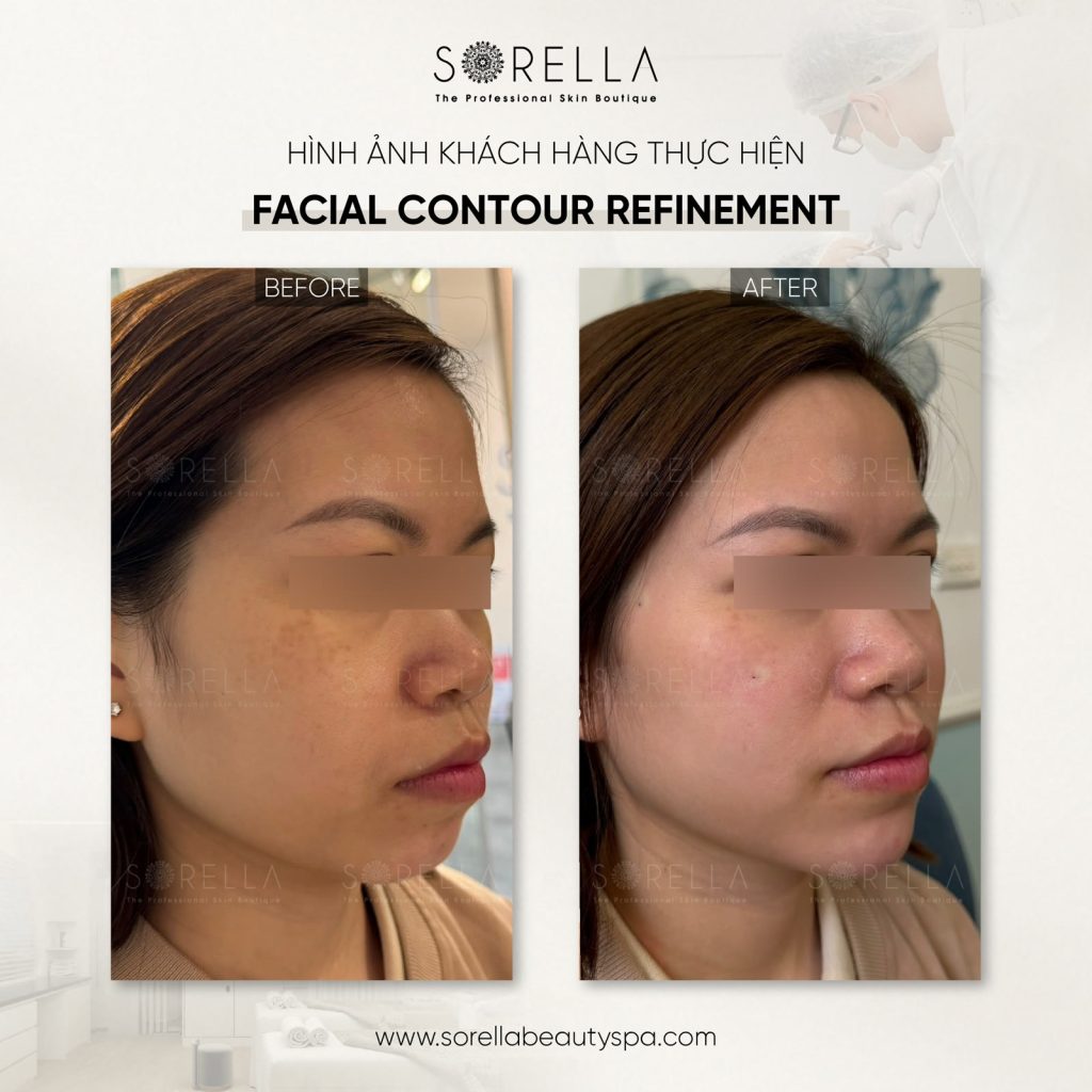 Thermage FLX - trước & sau