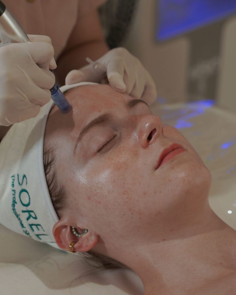 Micro Needling with Multi Vitamins